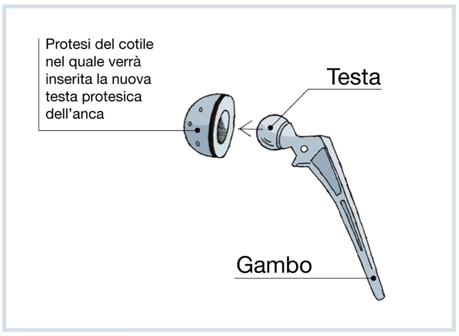 PROTESI ANCA