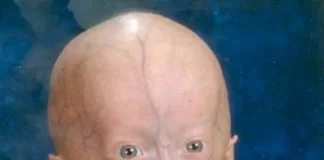 Progeria