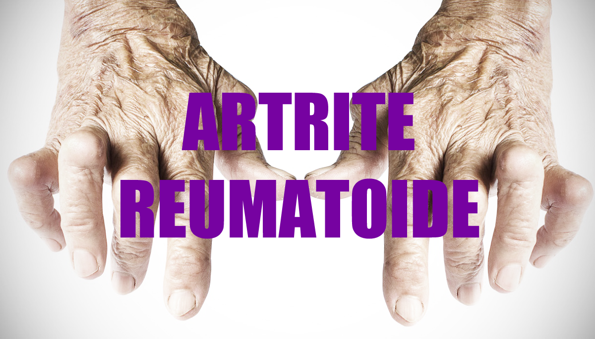 artrite reumatoide cos e sintomi diagnosi e terapie